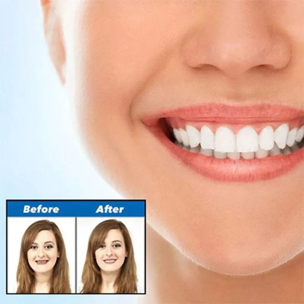 Виниры для зубов Perfect smile veneers. Голливудская улыбка